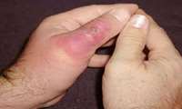 سم مار ها و اثر آن بر بدن متفاوت است/در صورت گزش مار فورا به مرکز درمانی مراجعه شود